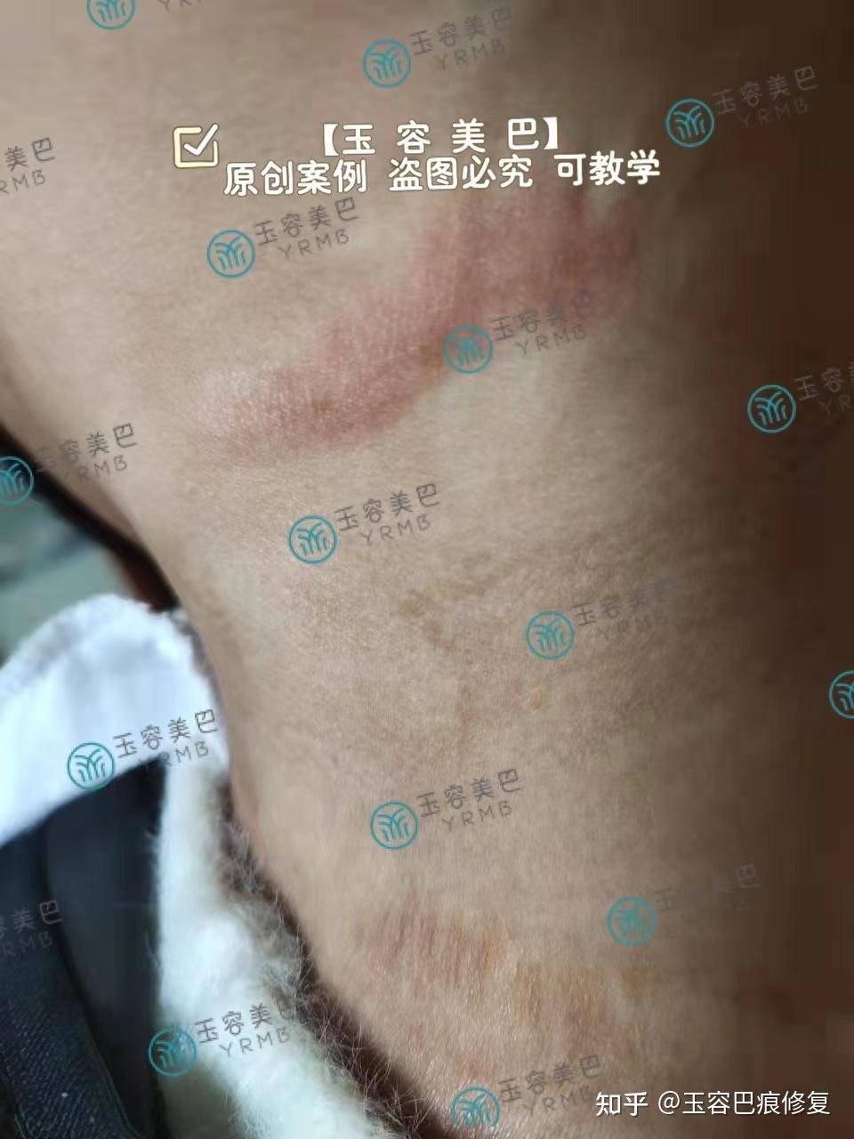 陈旧性增生疤痕修复对比图