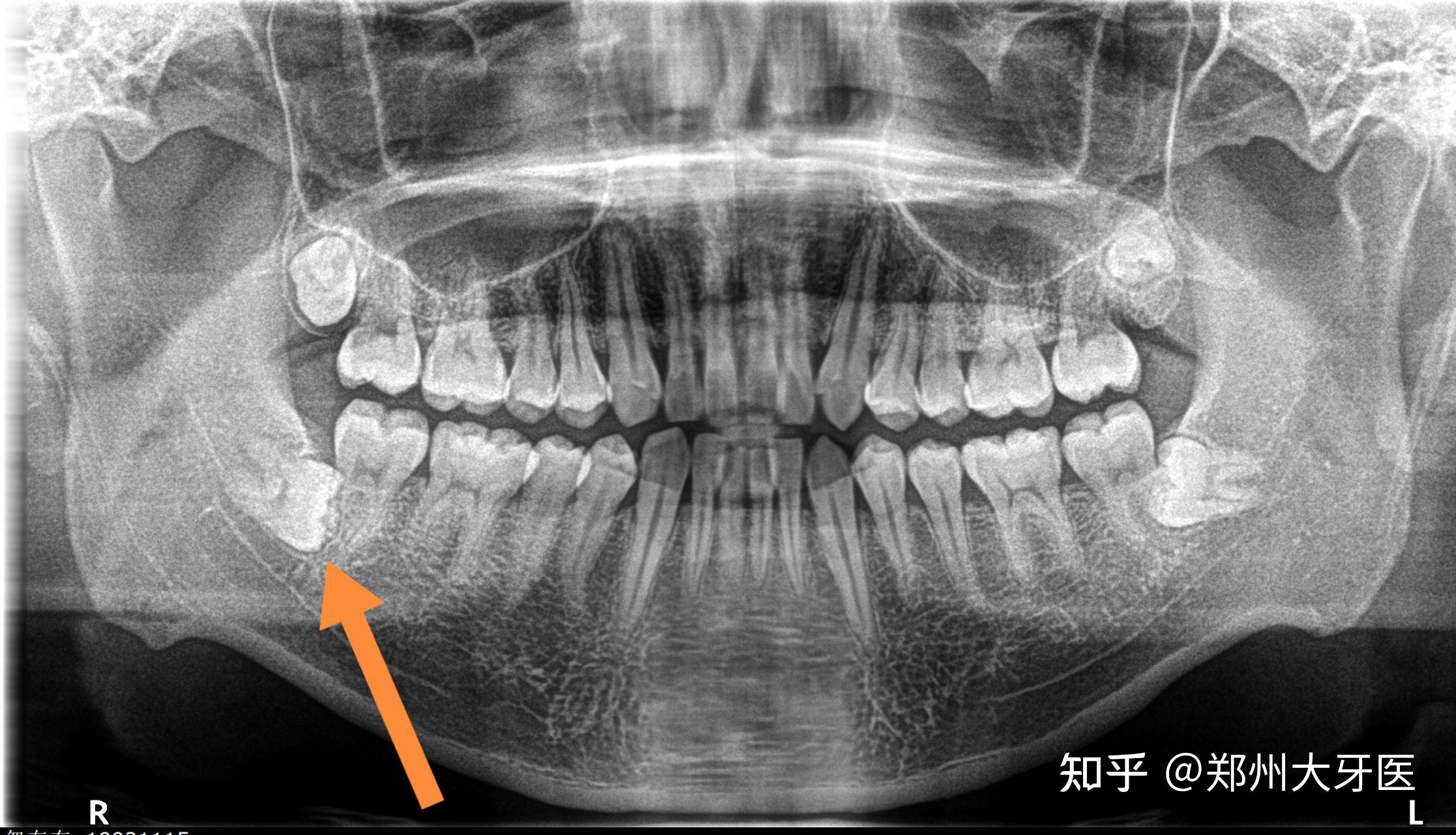 拔近中低位水平阻生智齿容易伤到神经吗