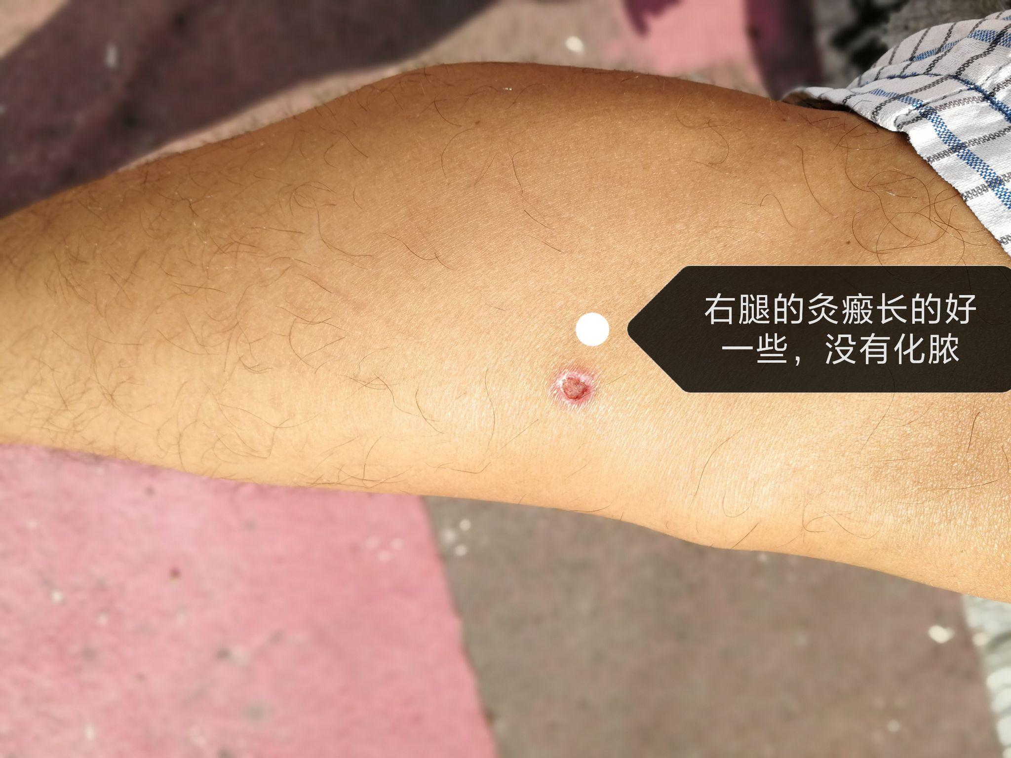 足三里瘢痕灸酸爽得不得了