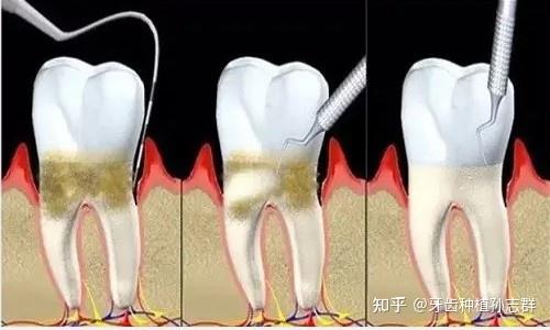 牙肉萎缩方法图片