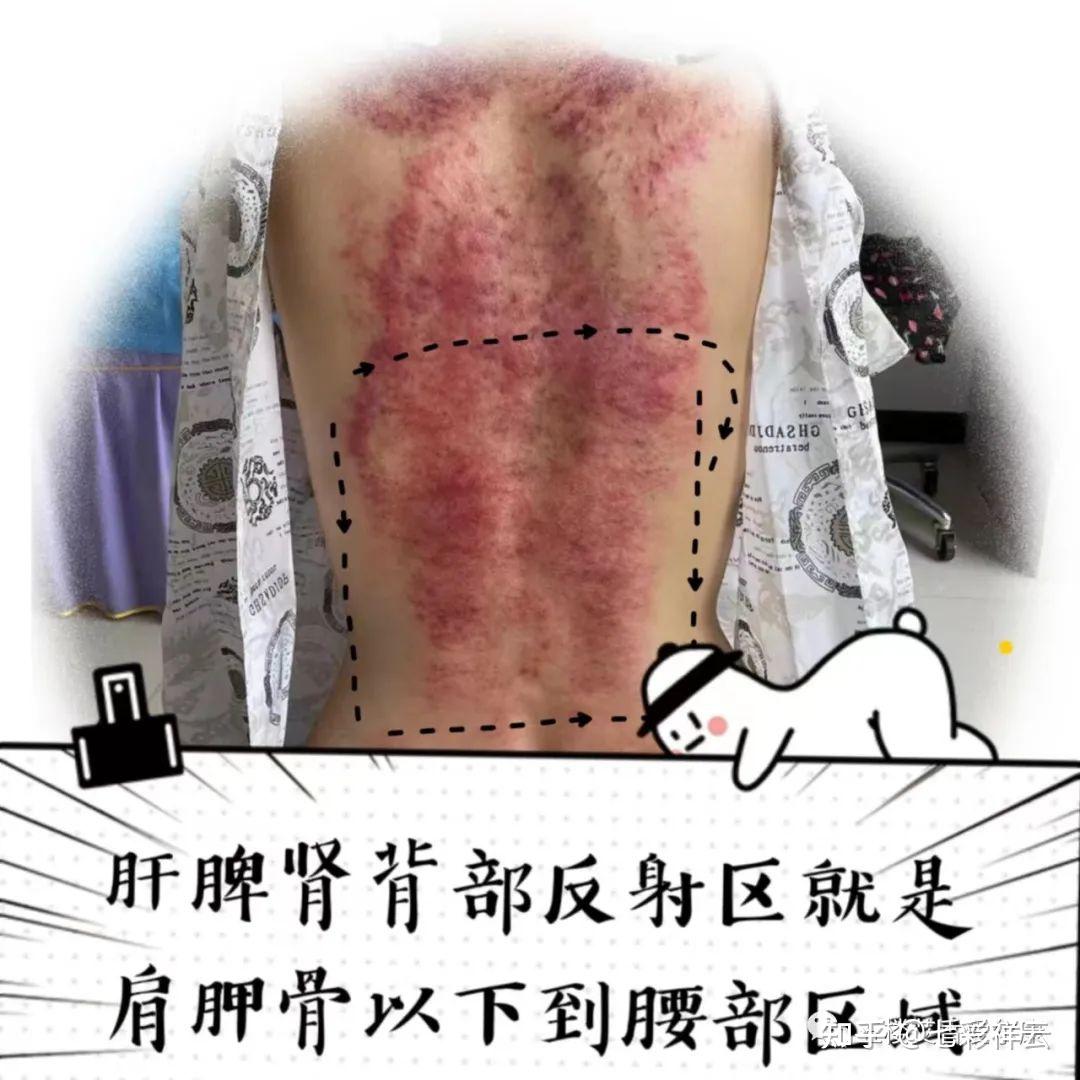 常见疾病刮痧方案总结含人体反射图,刮痧禁忌和痧像,痧味诊断疾病 - 知乎