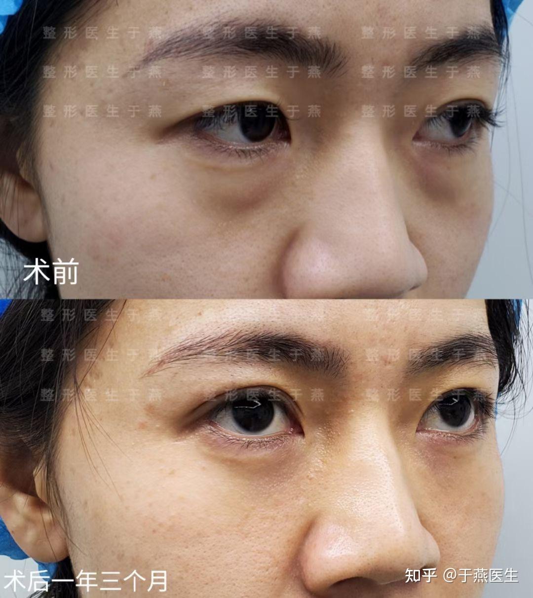 做完眶隔释放一两年以上的你觉得效果如何？ - 知乎