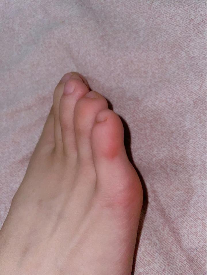 治冻疮的药有哪些每年冬天脚都长冻疮的人经验分享