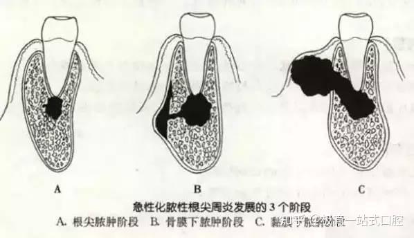 冠周炎是智齒牙冠周圍軟組織發生的非特異性炎症,常見的症狀有智齒