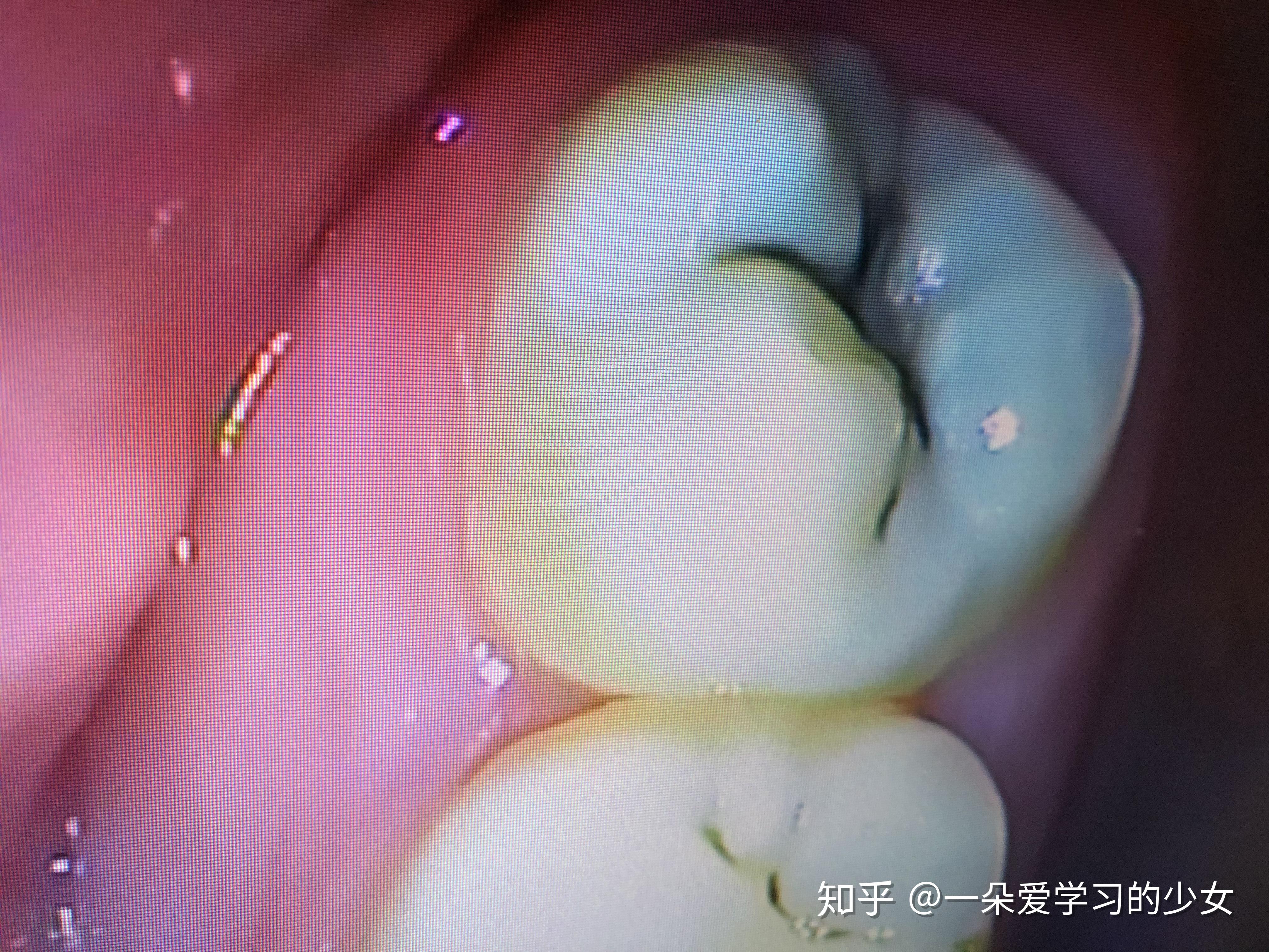 门牙龋齿,槽牙补过两次