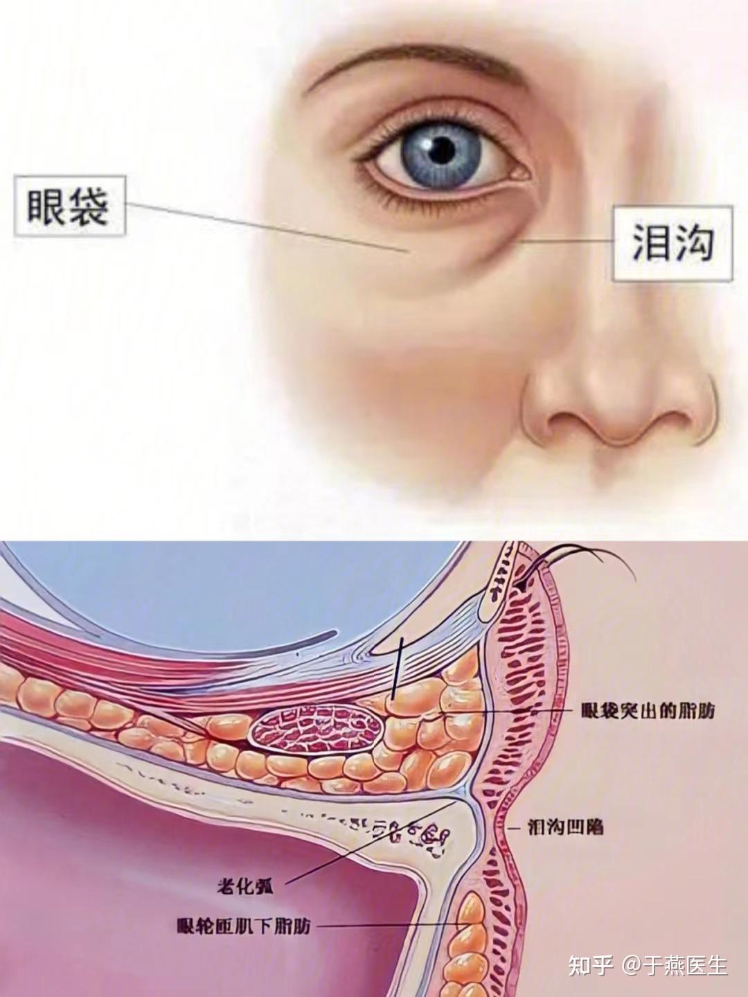 内切眼袋和内切眼袋眶隔有什么不同？只做内切眼袋可以吗？ - 知乎