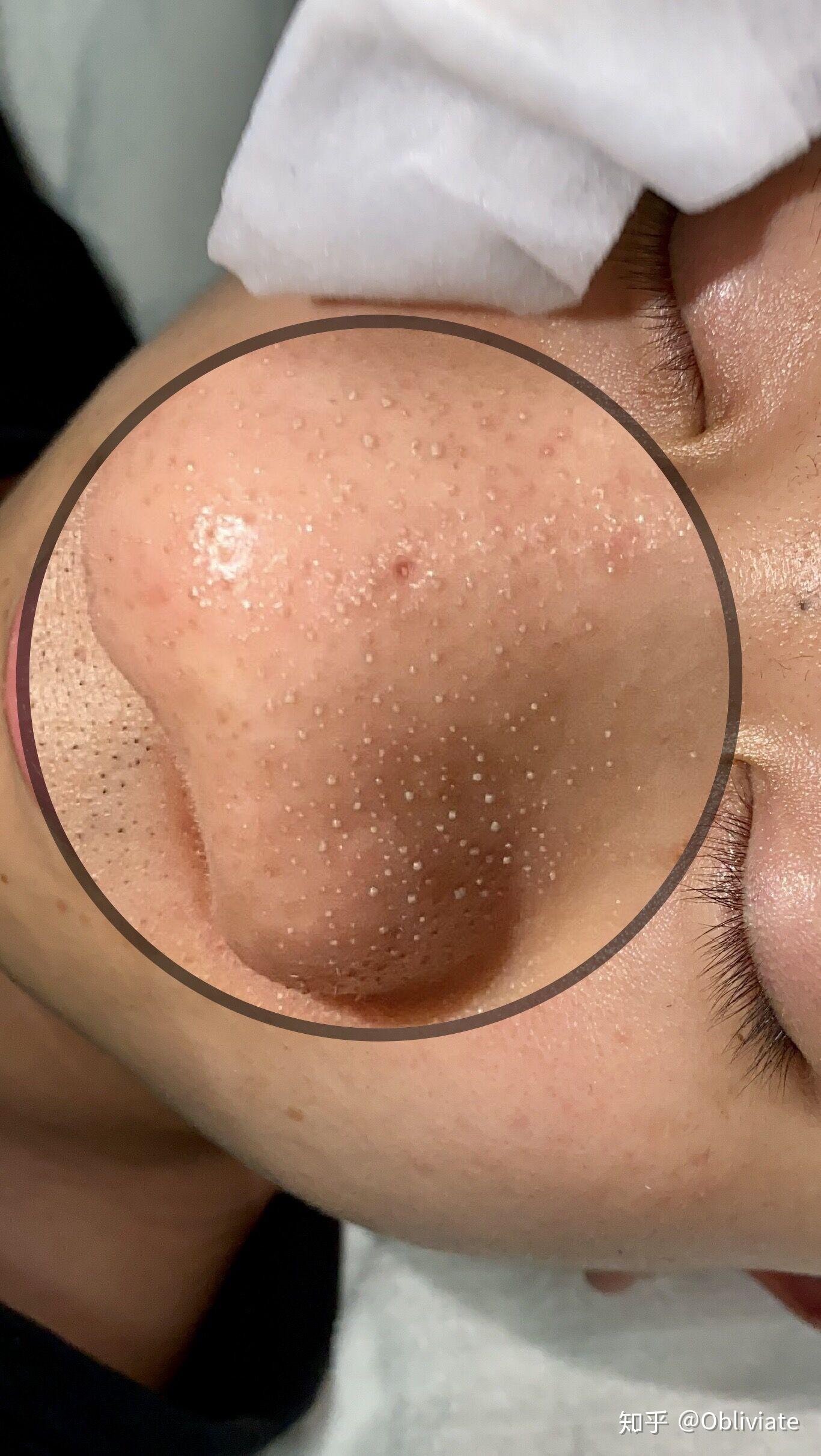 毳毛黑头怎么去呀? - 知乎