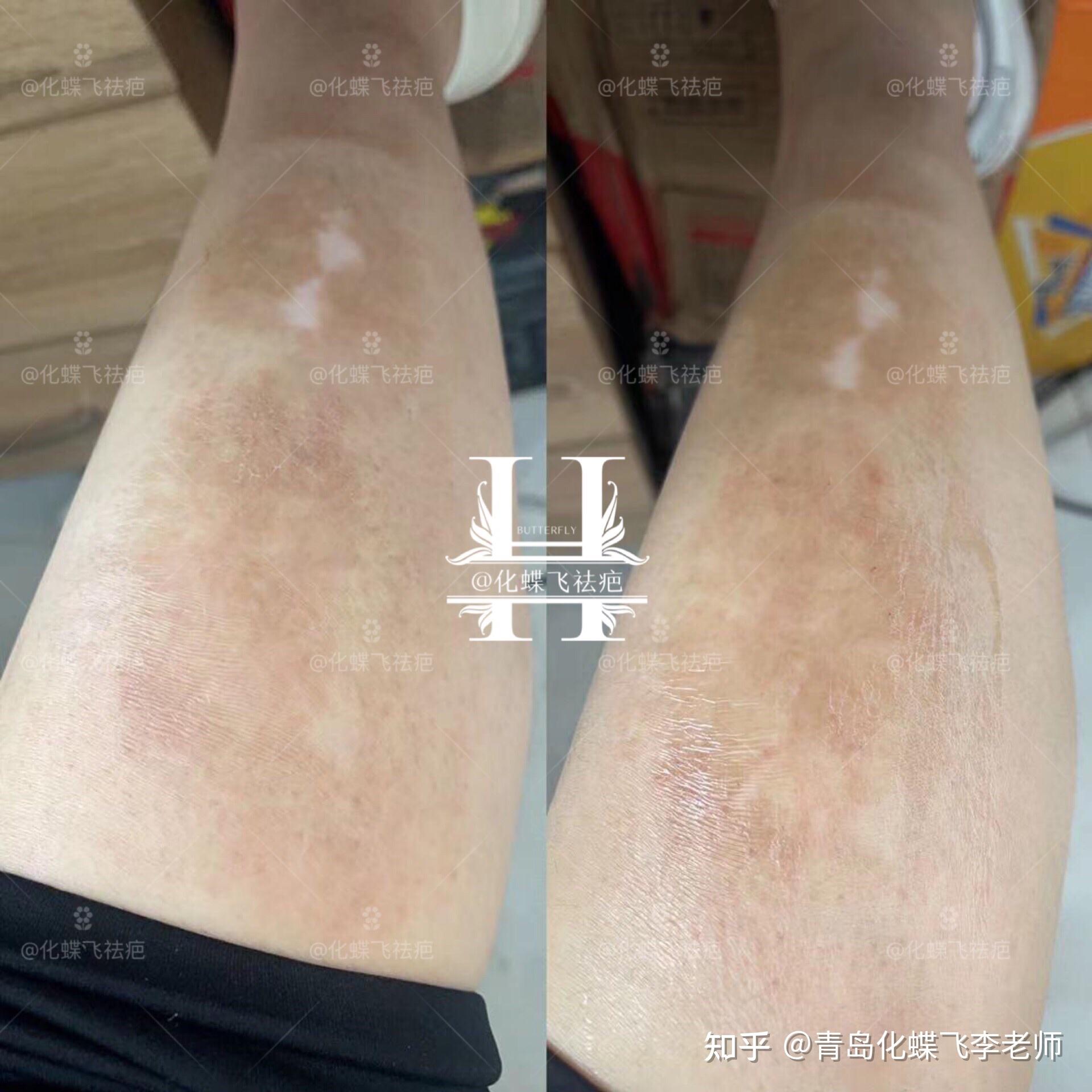 大面积色素沉淀疤痕 - 知乎