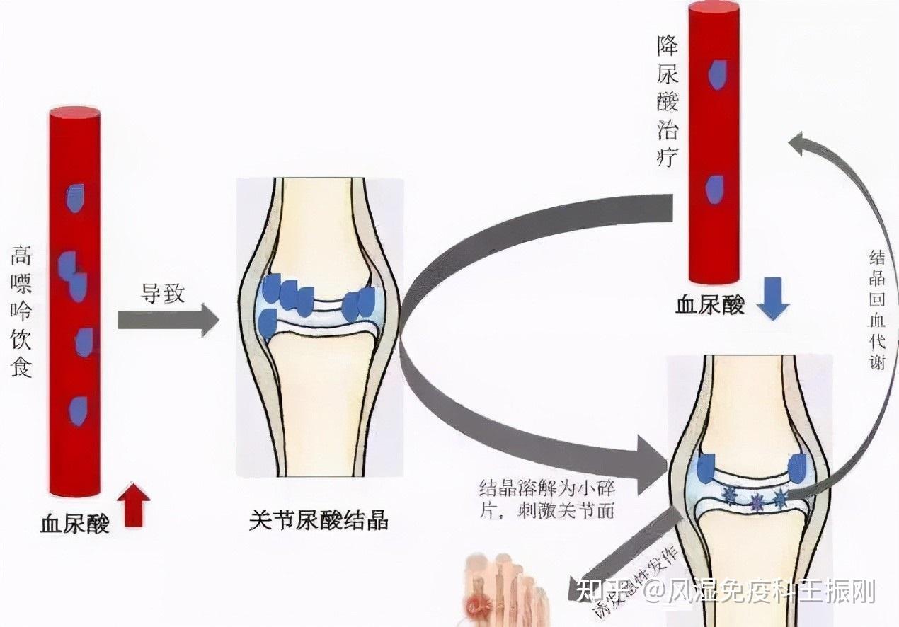 痛风定胶囊降尿酸原理图片