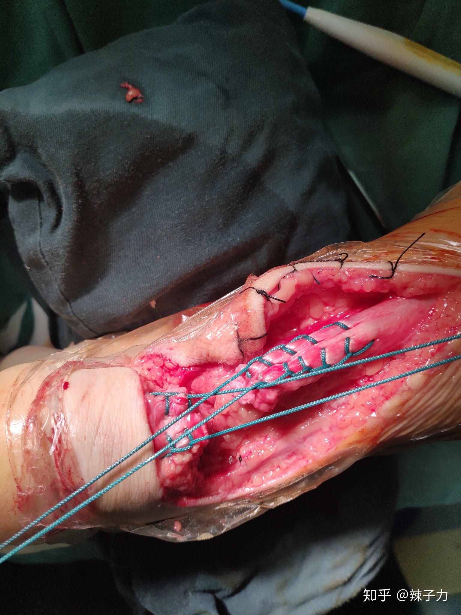 跟腱断裂之后手术是如何接上的呢