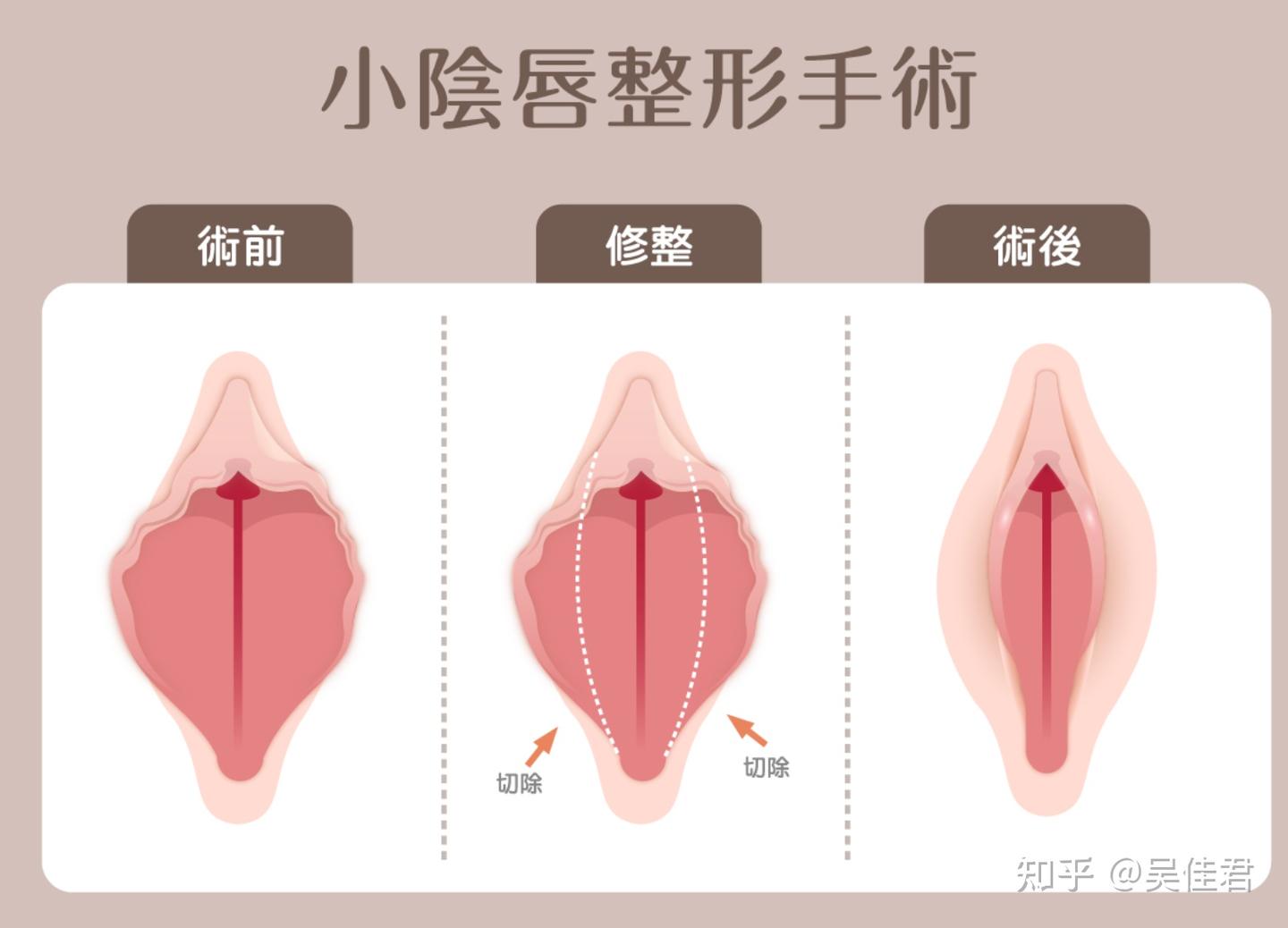 小阴唇 科普丨私密整形术- 知乎