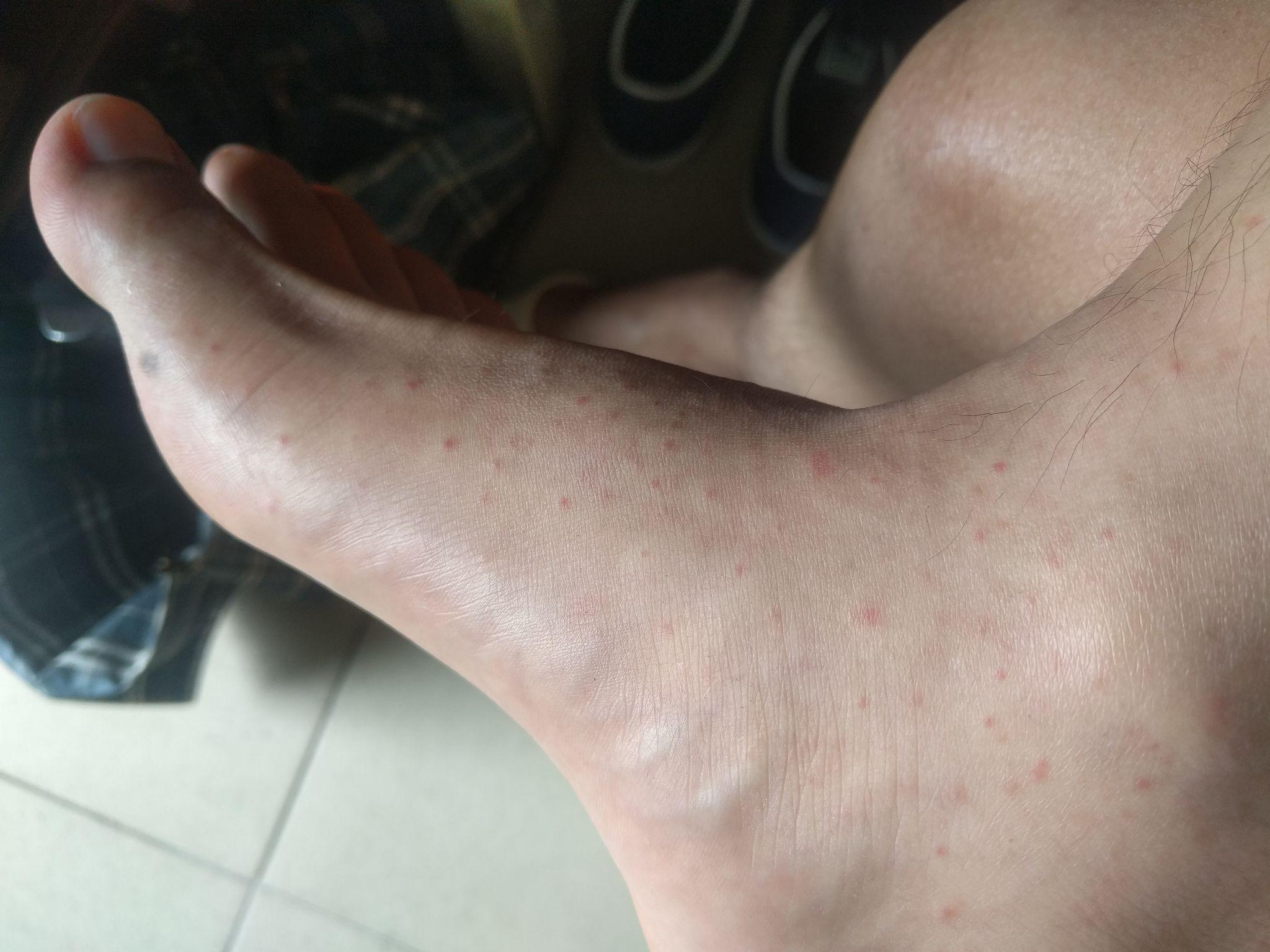 腿上长了许多小红点不痛不痒有谁知道是什么吗