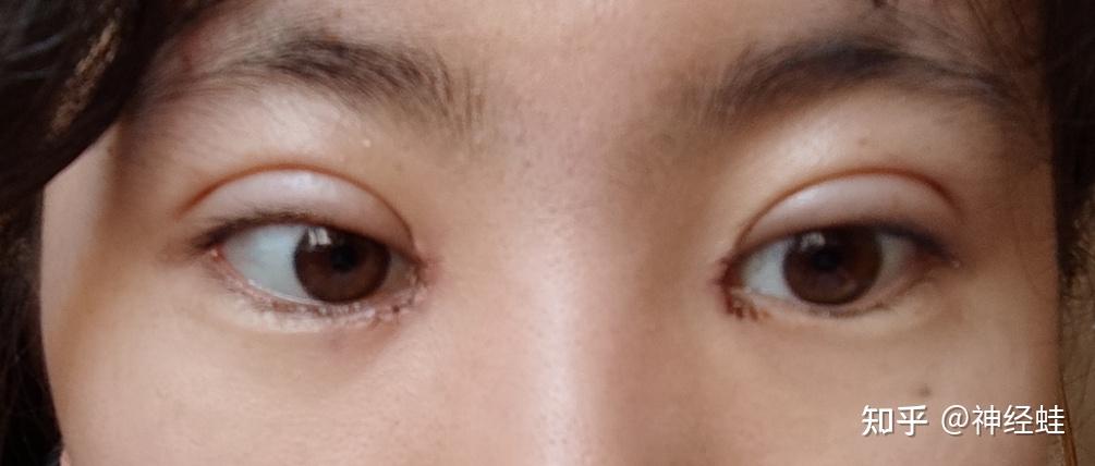 缝线重睑法(缝线双眼皮)有什么优缺点? - 知乎