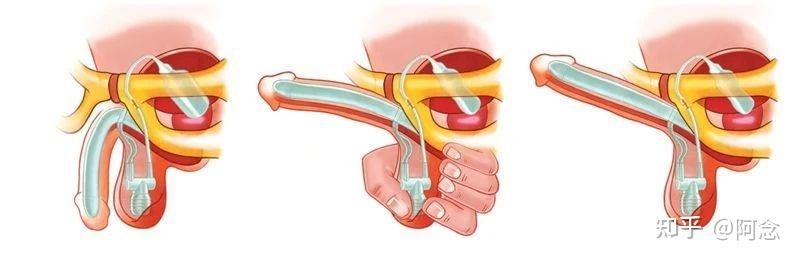 什么是阴茎硬结症