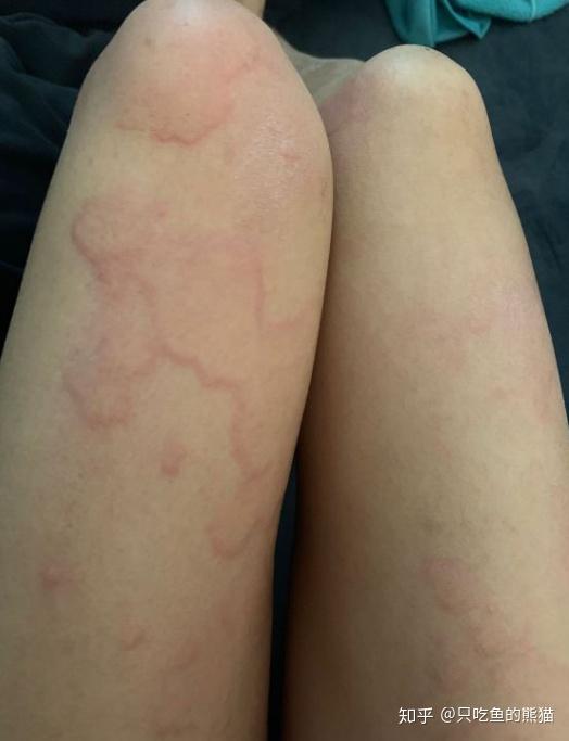 求过敏体质荨麻疹春季逃生指南