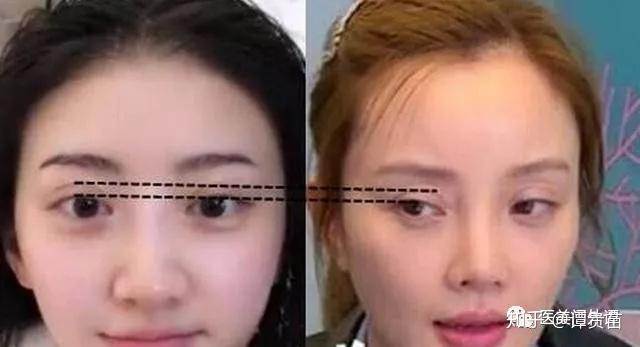 医生给我做个宽宽的双眼皮能夹死蚊子那种