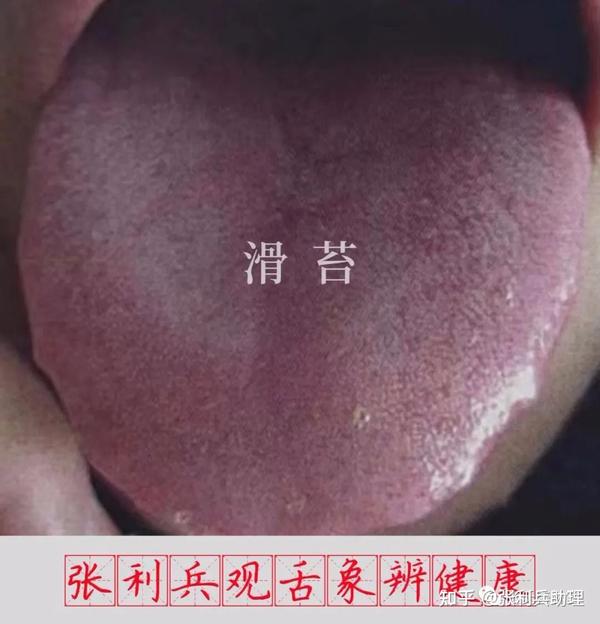 张利兵：“观舌象辨健康”第32讲--舌苔辨证诊病之润苔与燥苔 - 知乎