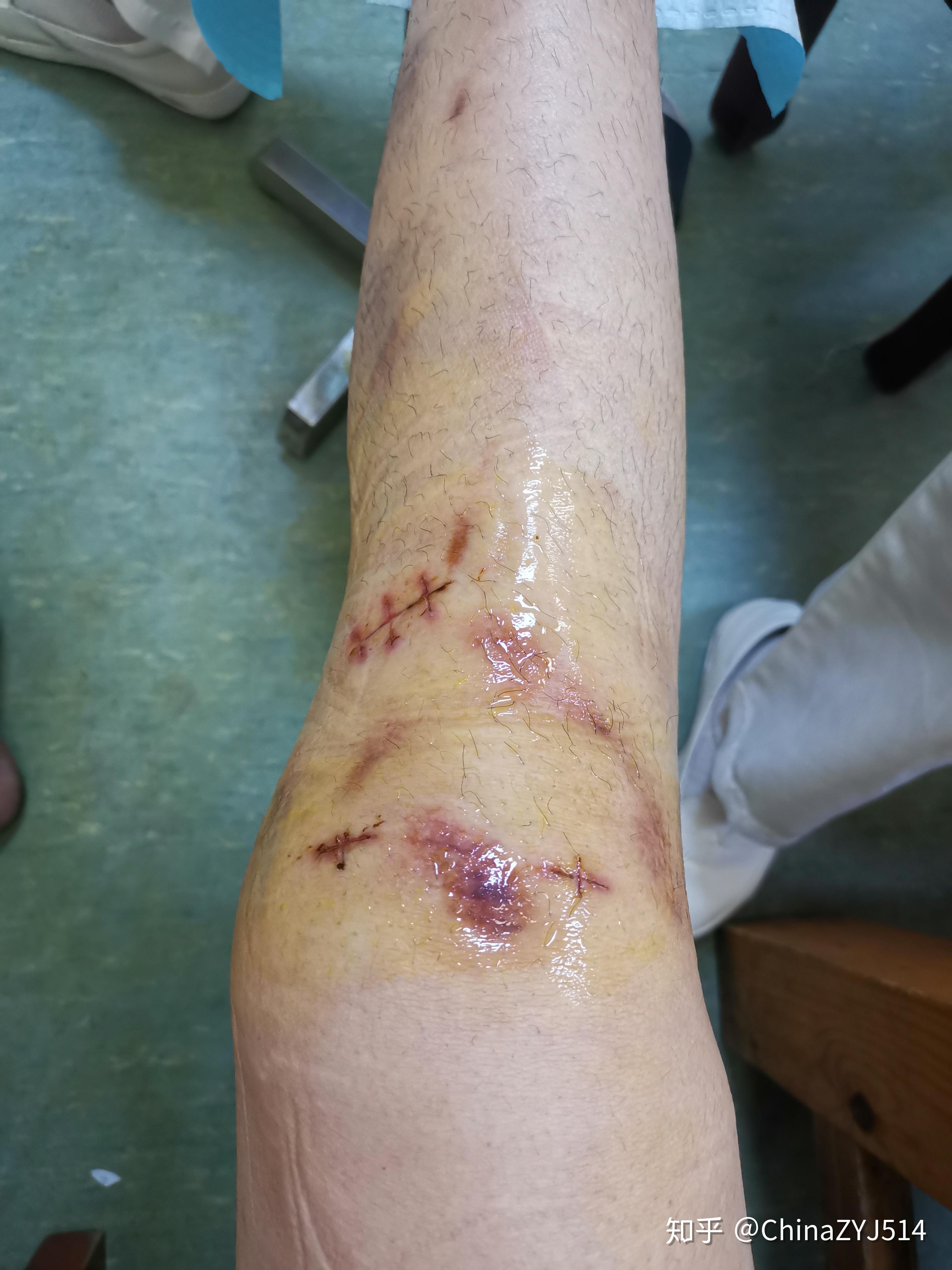 前交叉韧带断裂术前术后经历分享 - 知乎