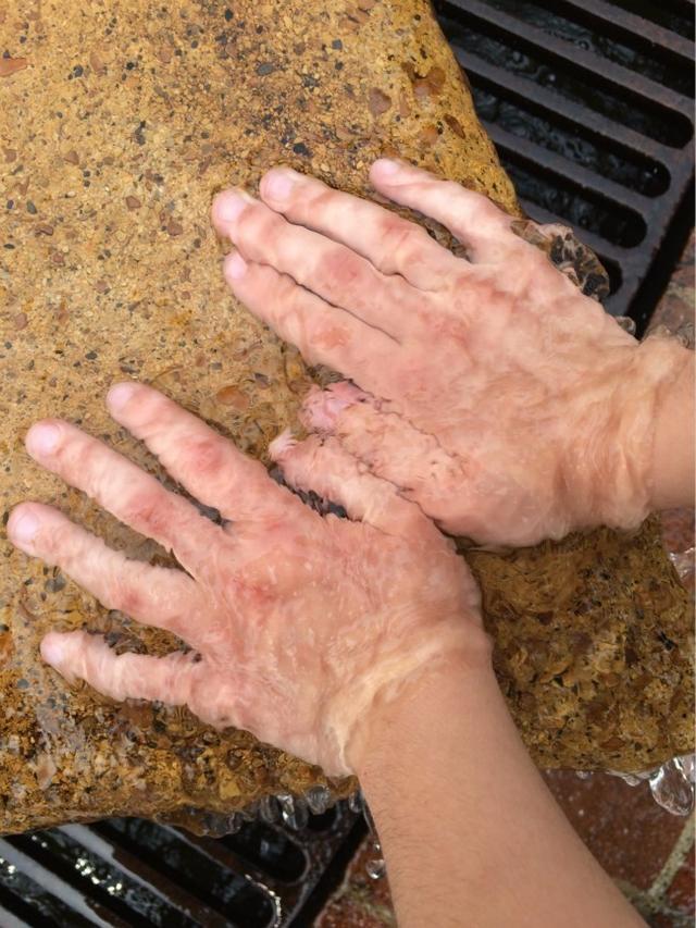 宝宝烧烫伤请牢记5步急救法家长必看