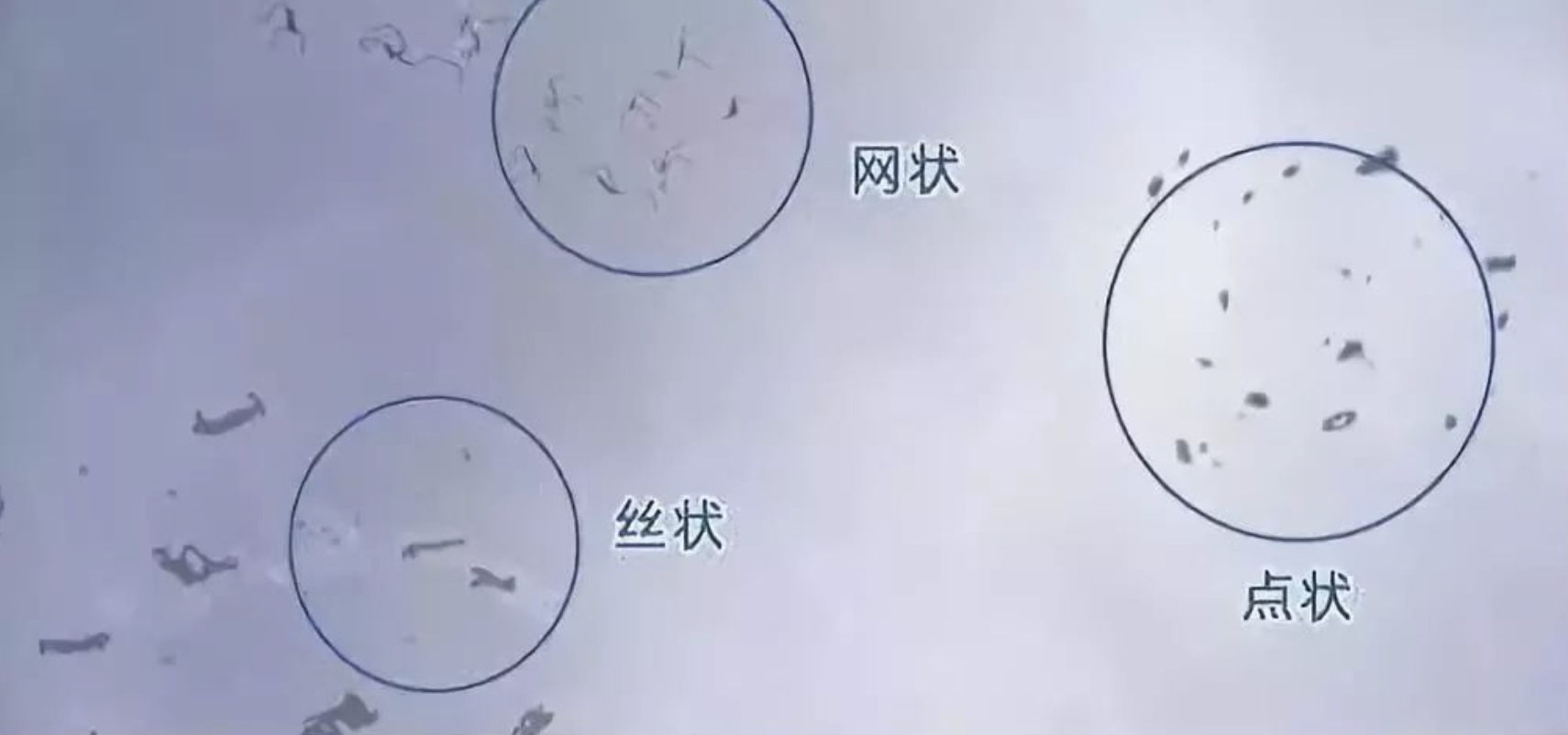 飞蚊症(玻璃体混浊)会自己消失吗? - 知乎