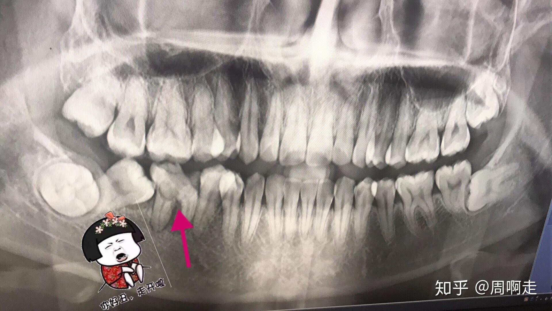 蛀牙一定會痛嗎？補牙後導致「再蛀牙」的3大原因｜悅庭牙醫診所