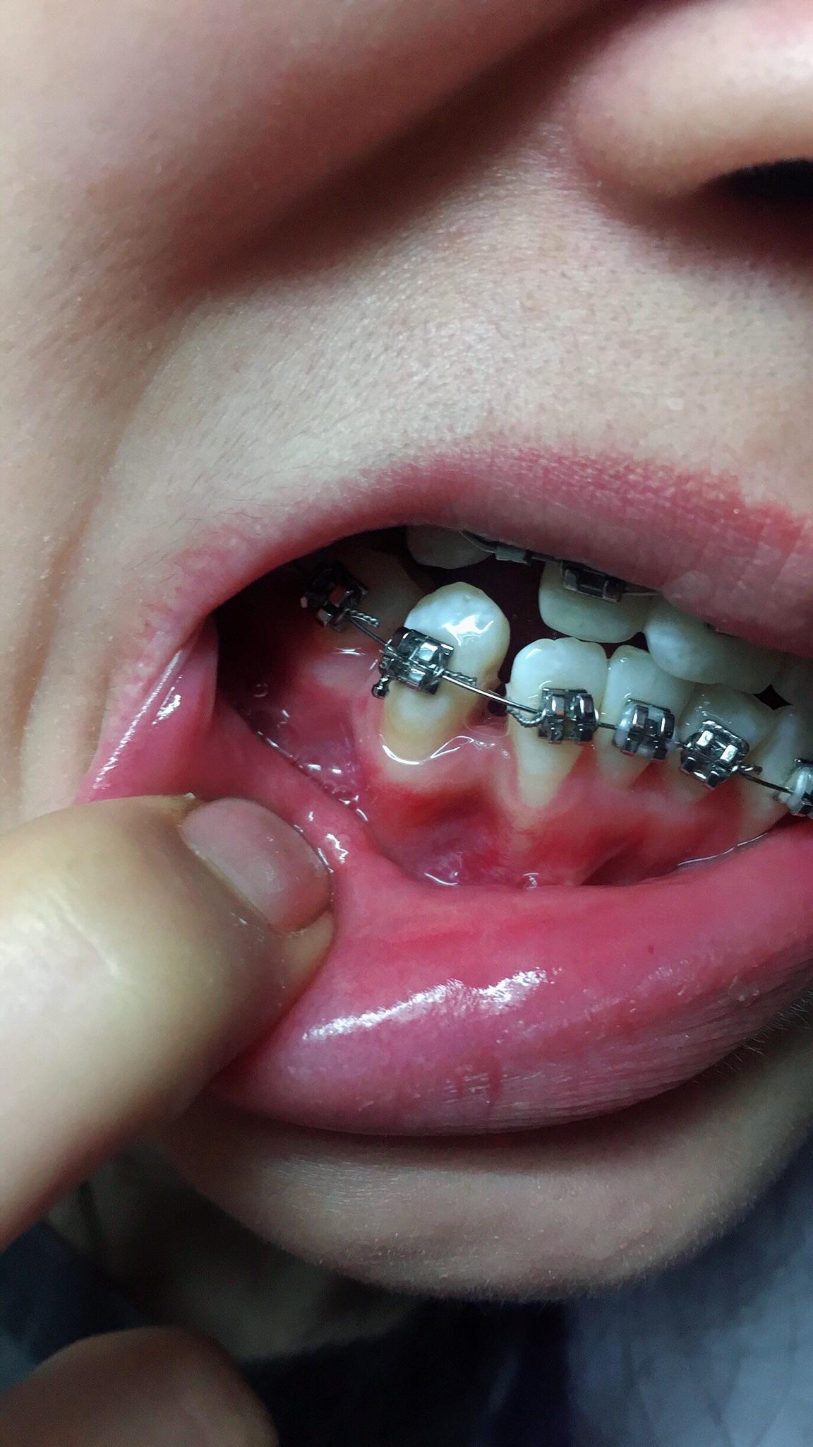 牙龈萎缩适合做牙齿正畸吗