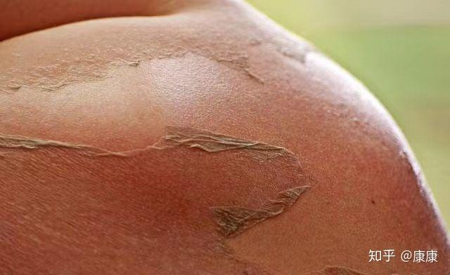 重度晒伤——长时间暴晒后出现水泡,蜕皮,甚至头晕恶心等不良症状
