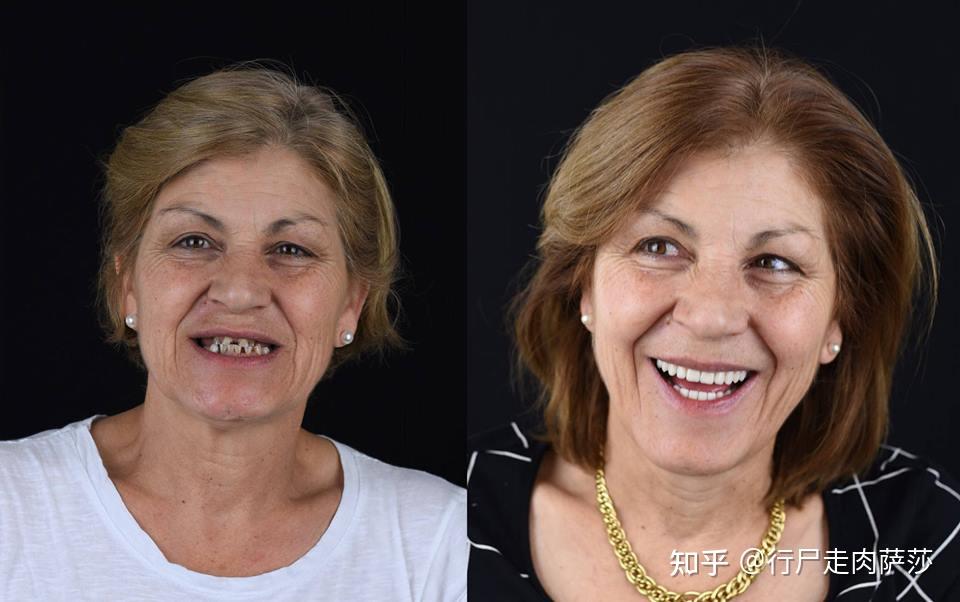 牙齿与脸型骨相之间的关系(拔牙正畸 磨牙症患者 中老年牙齿磨耗