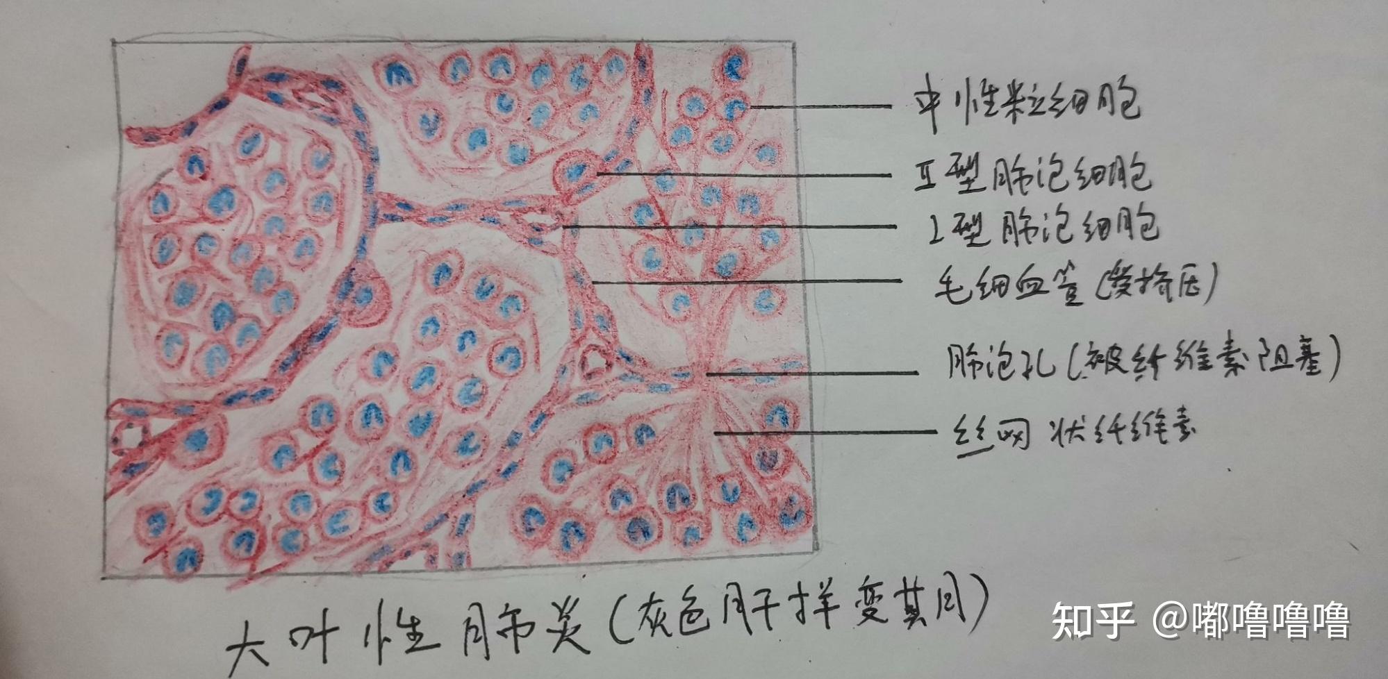 肺炎杆菌荚膜染色绘图图片