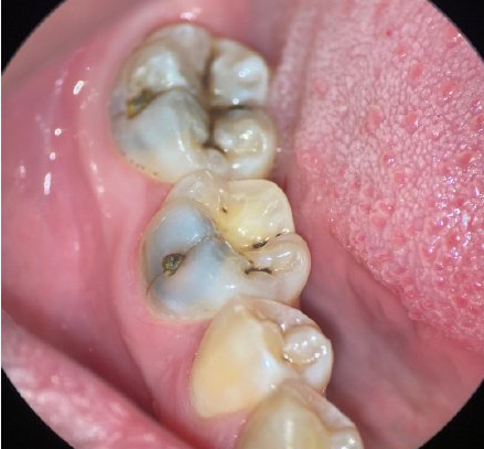 在线解答什么情况需要杀牙神经