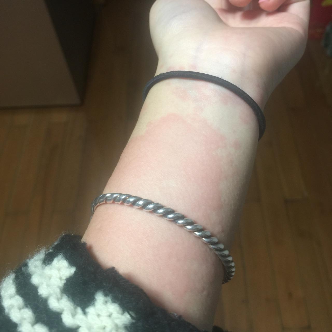 对动物毛过敏是一种怎样的体验? - 知乎