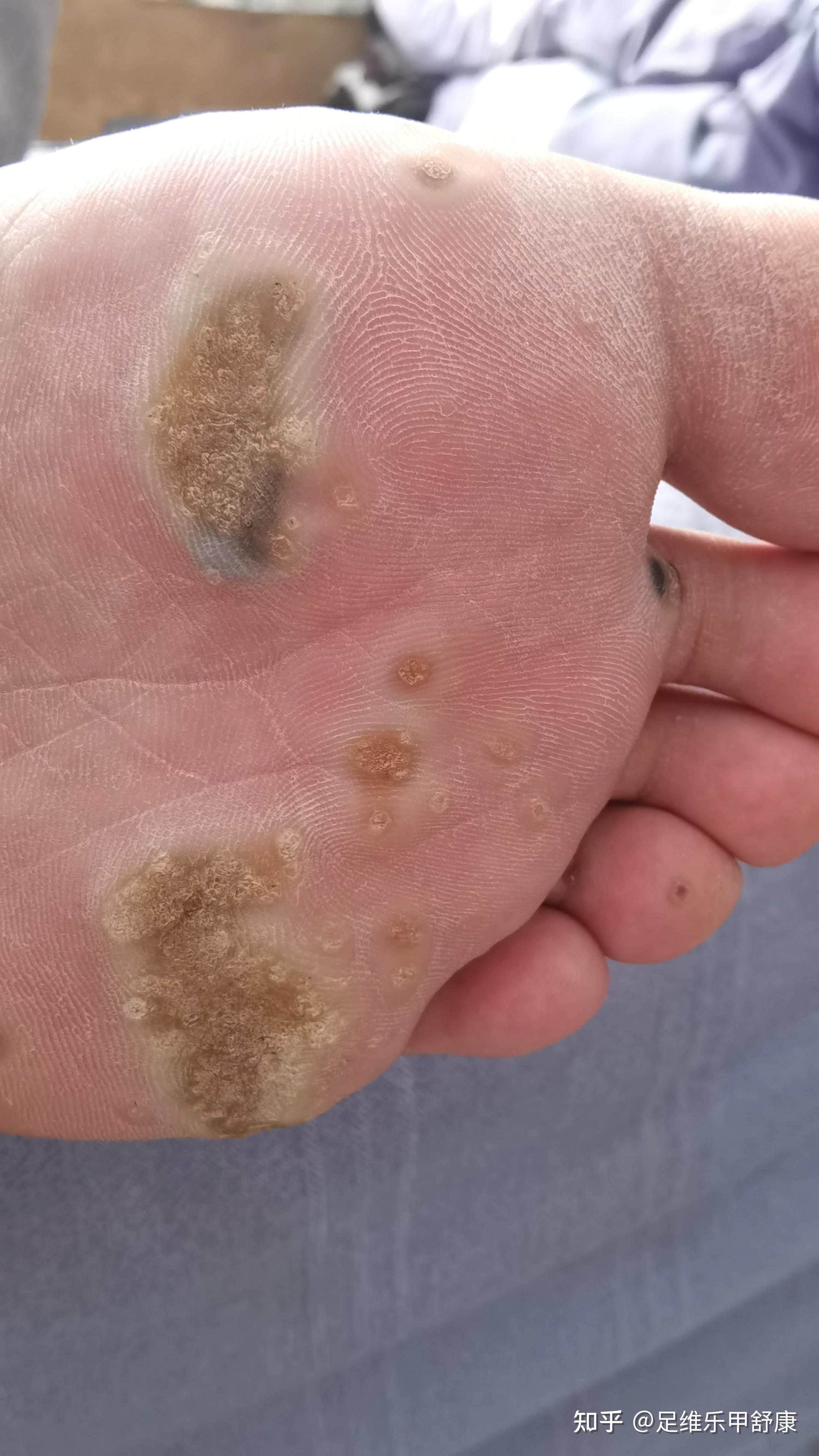 大片跖疣的最好治疗方法? - 知乎