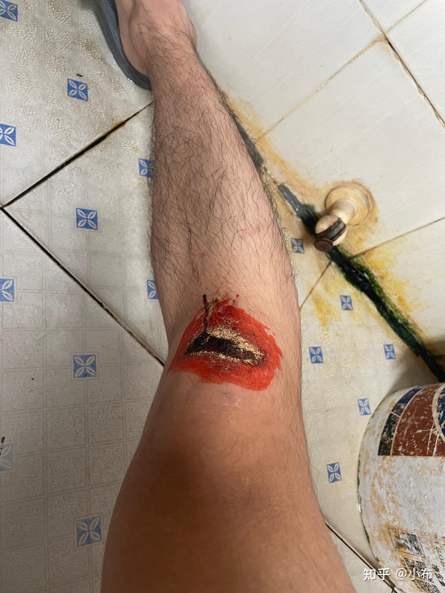 膝盖磕伤了怎么上厕所? - 知乎