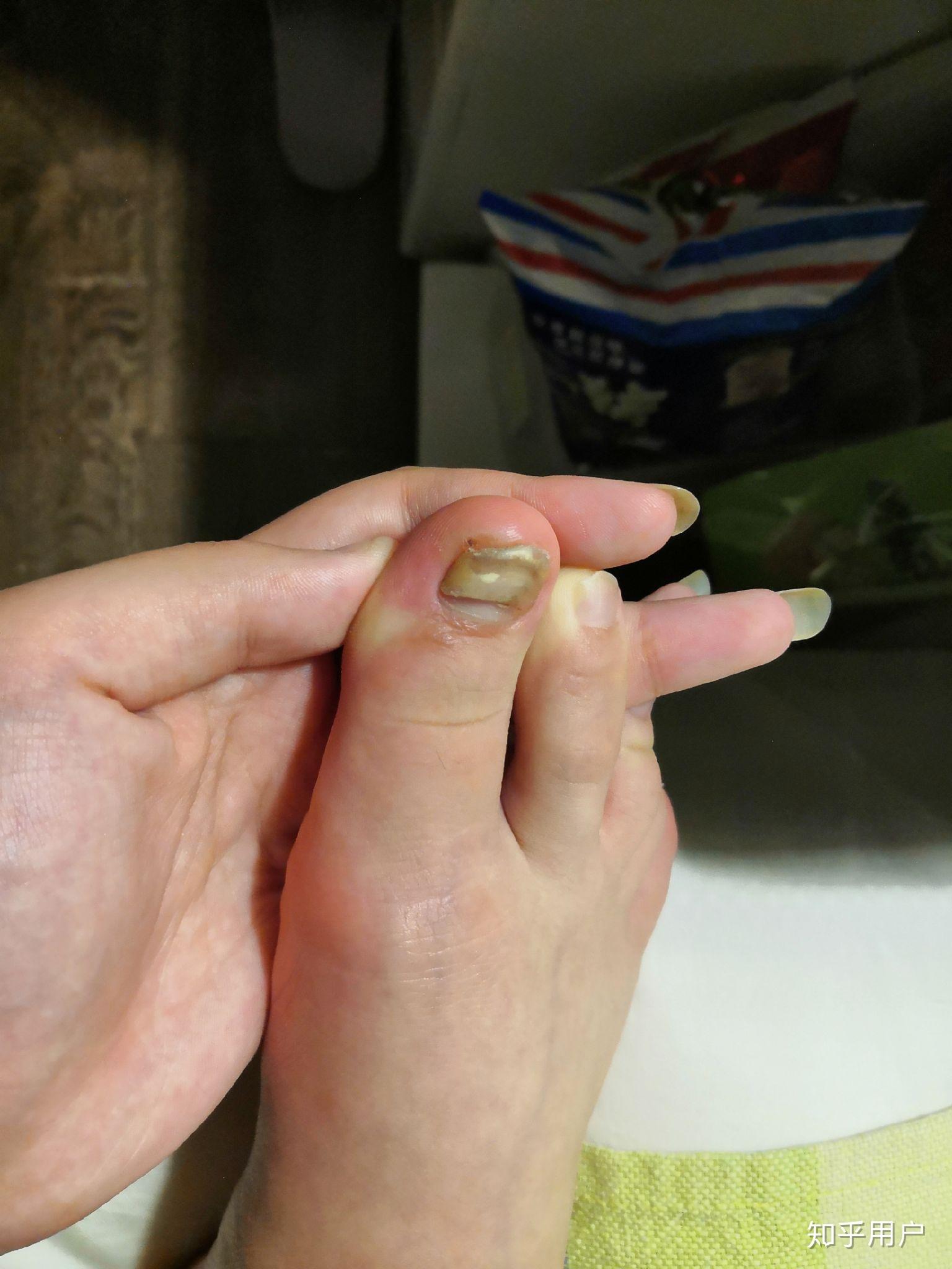 指甲盖掉了是怎样的一种体验