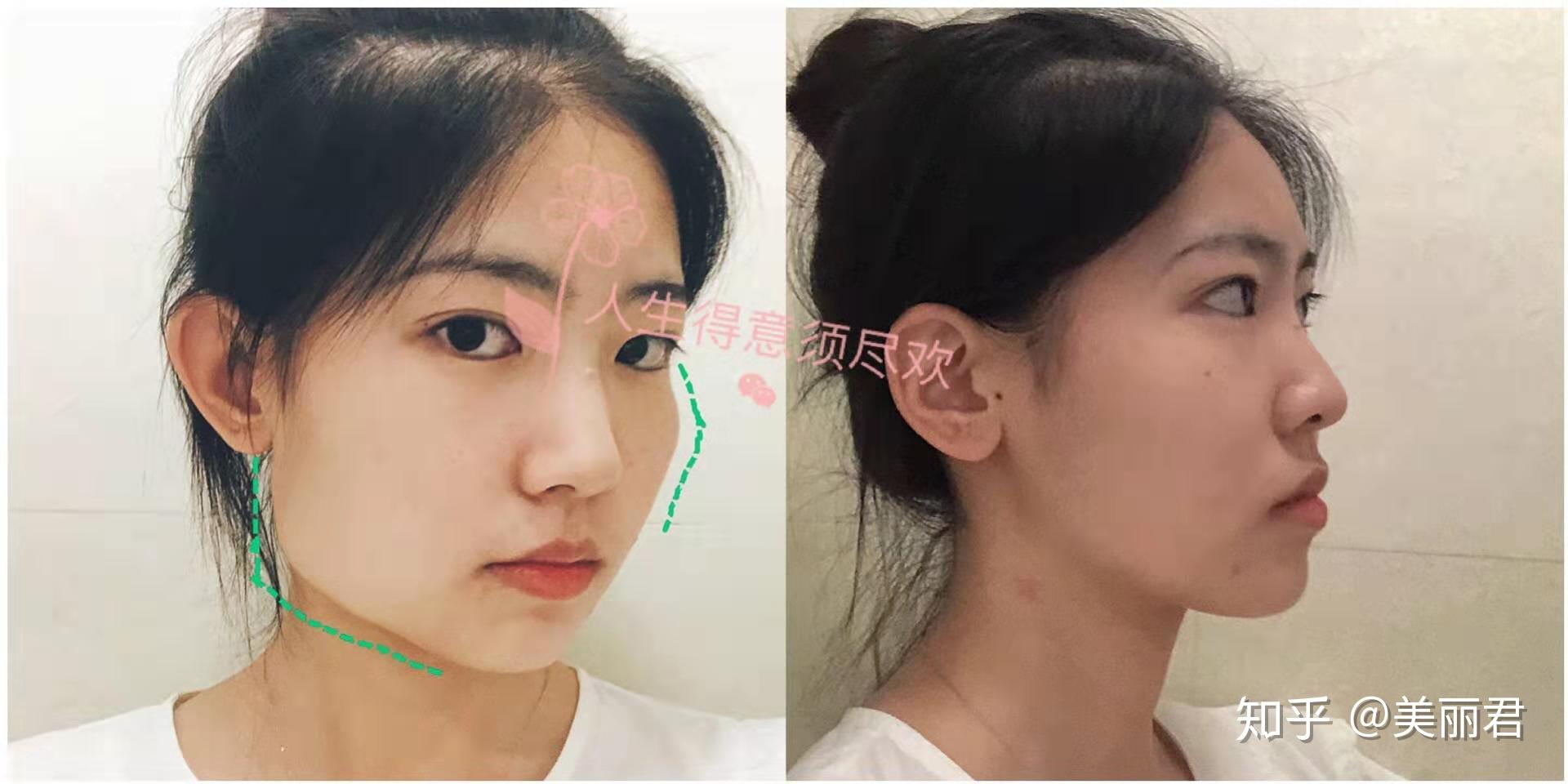 整容手术中削骨跟磨骨有什么区别价钱多少多长时间恢复手术的后遗症