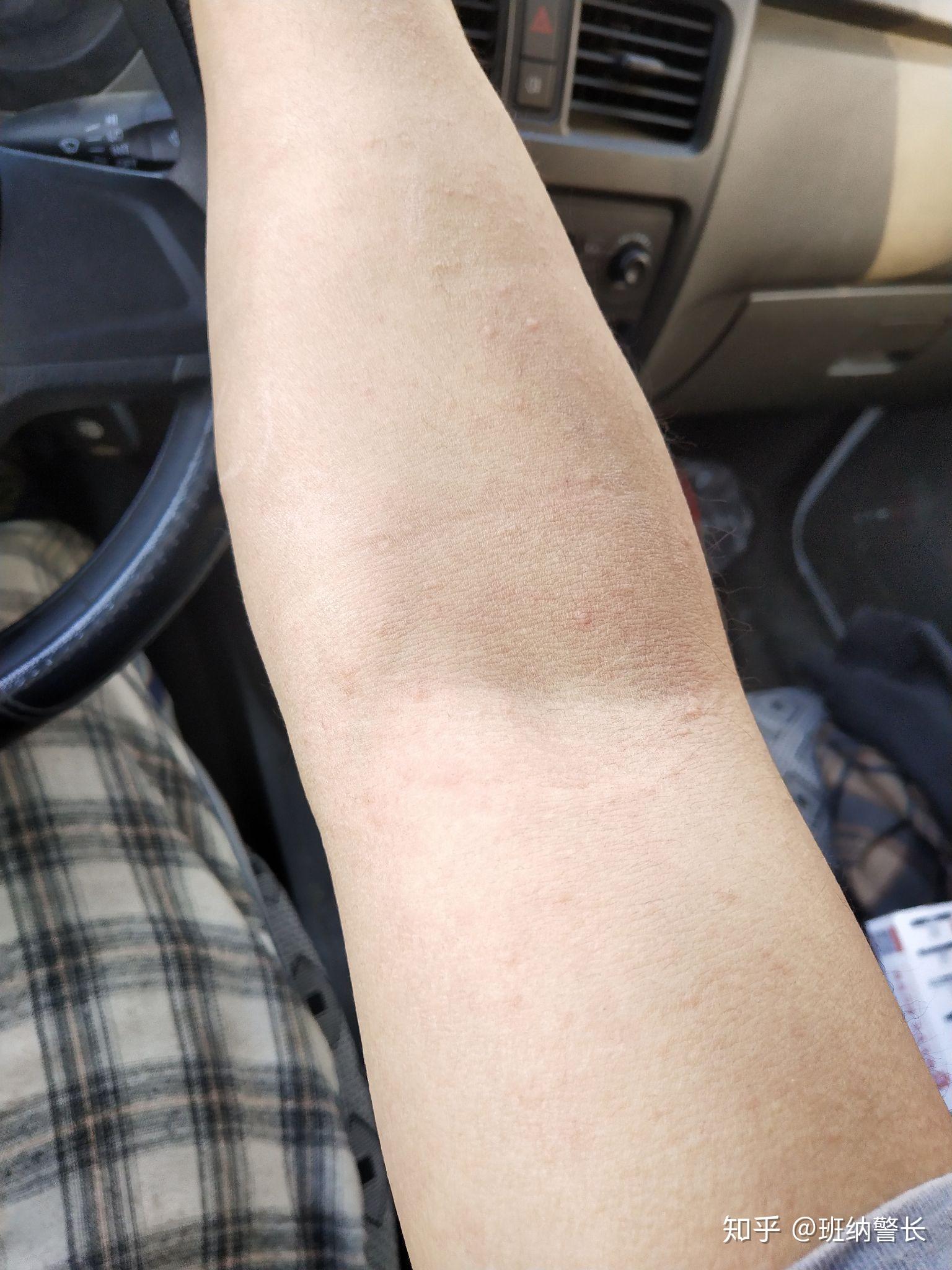 胆碱能性荨麻疹加焦虑症是一种什么体验