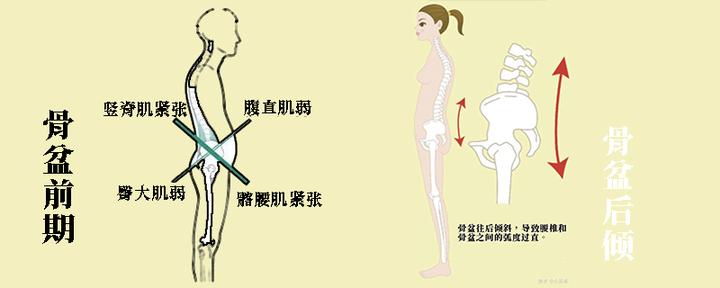 骨盆前倾和后倾傻傻分不清 一文搞懂这俩体态问题的异同 知乎 骨盆前倾和后倾傻傻分不清 一文搞懂这俩体态问题的异同 知乎