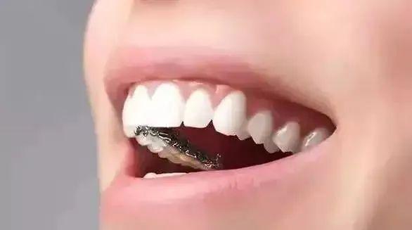 一文看懂舌侧矫正 | 口腔正畸科普文,值得收藏 - 知乎