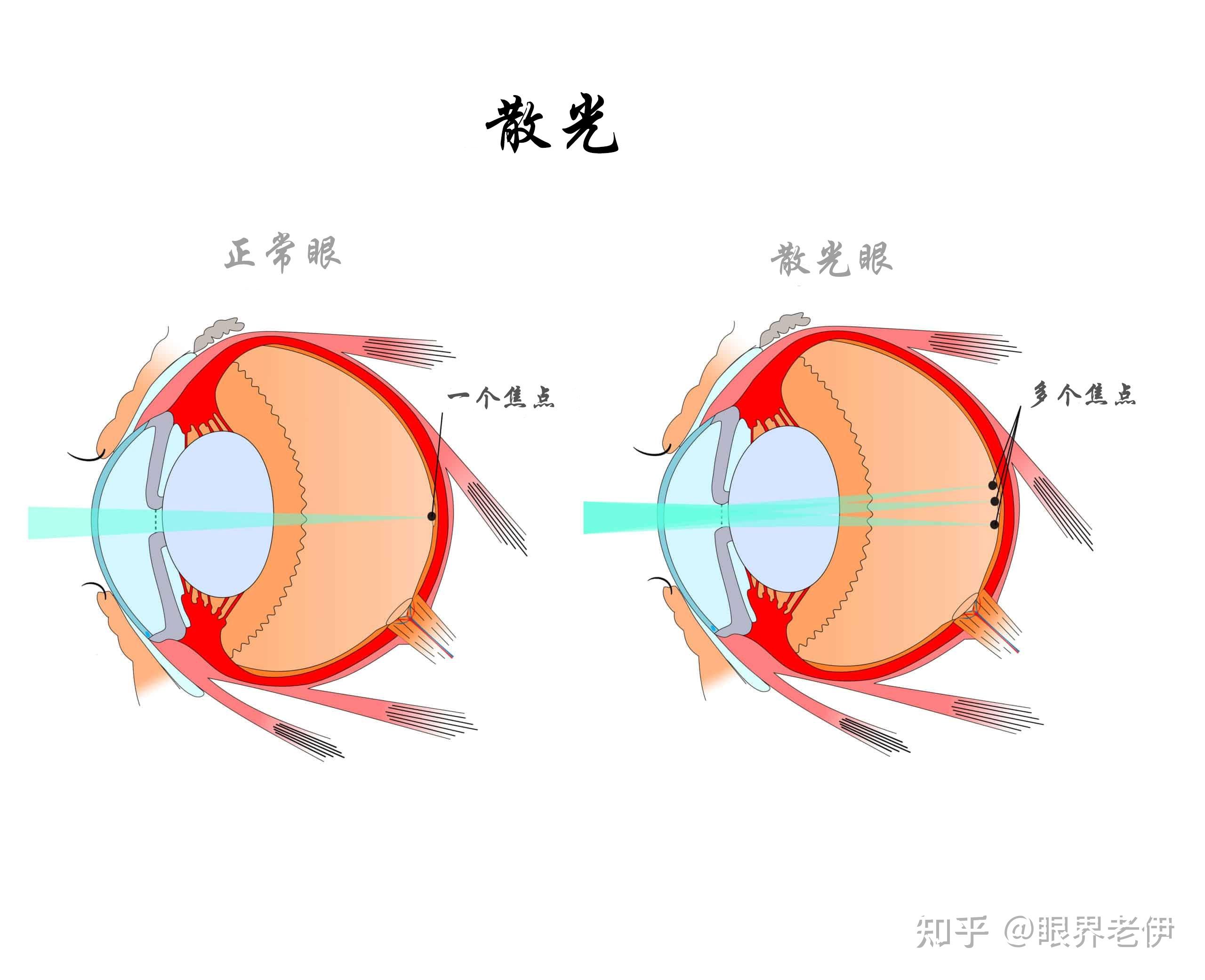 散光可以做近视手术吗
