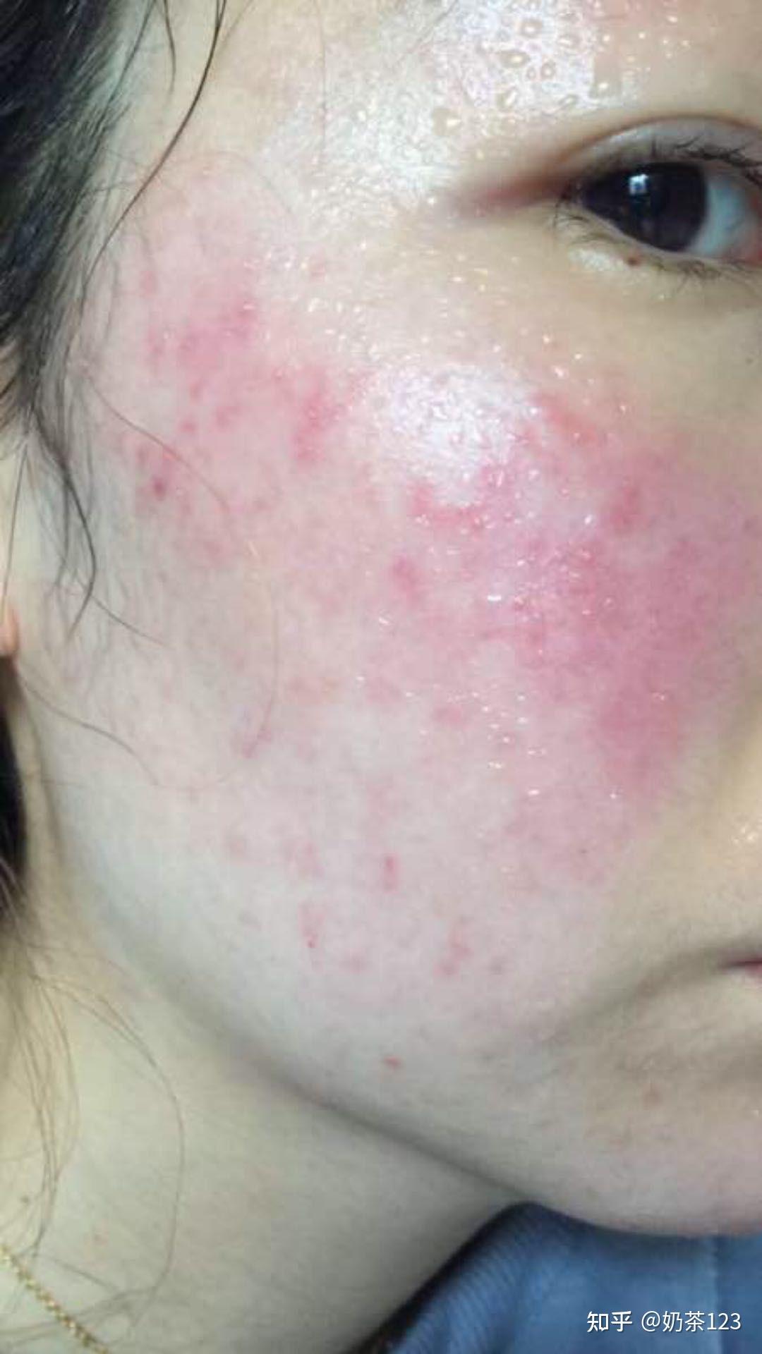 附当时照片两张刚开始得激素脸我是夏天我把玫这个品牌停掉开始 