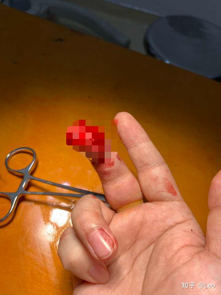 被10kg的哑铃砸到手指是怎样一种感受? - 知乎