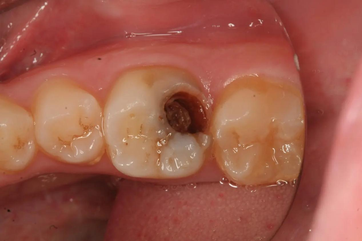 牙齿侧面蛀牙补牙图图片