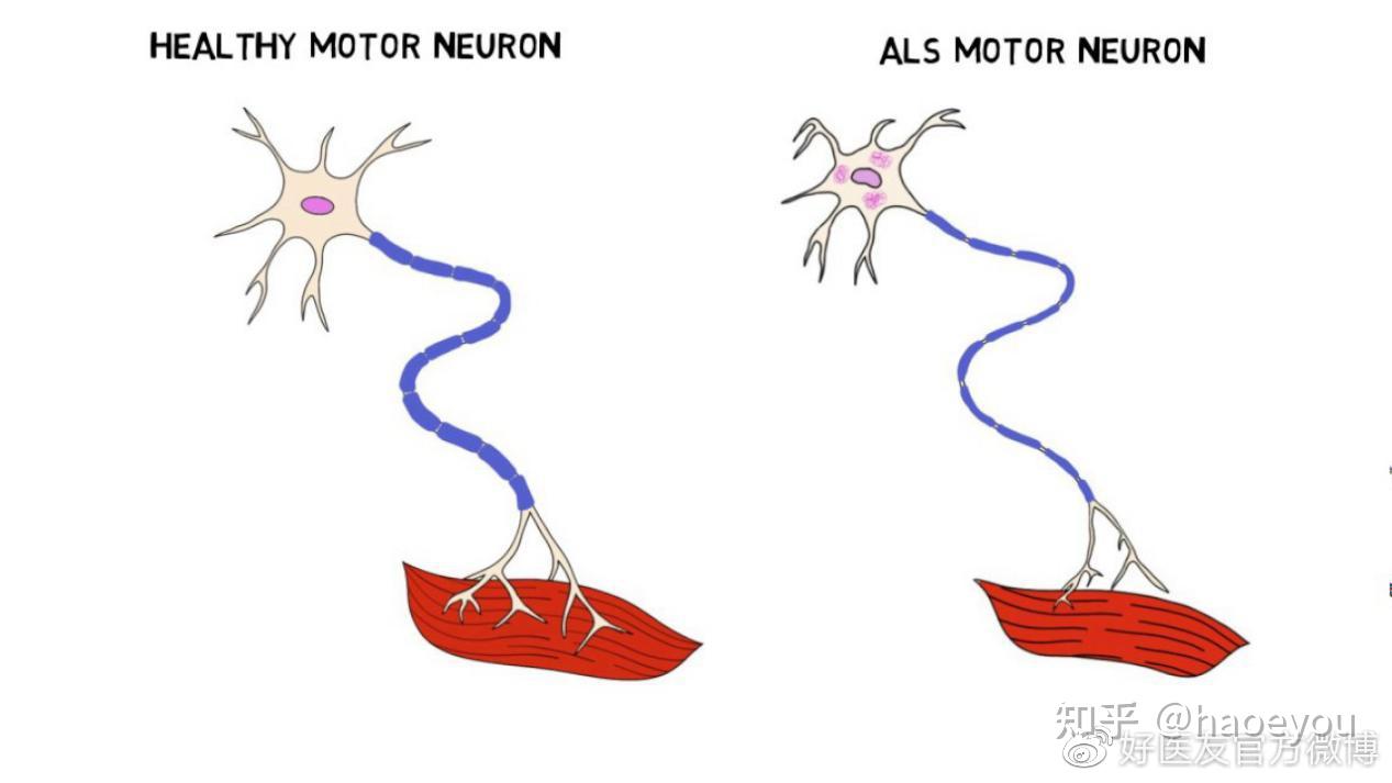 上运动神经元是大脑的运动"总司令".