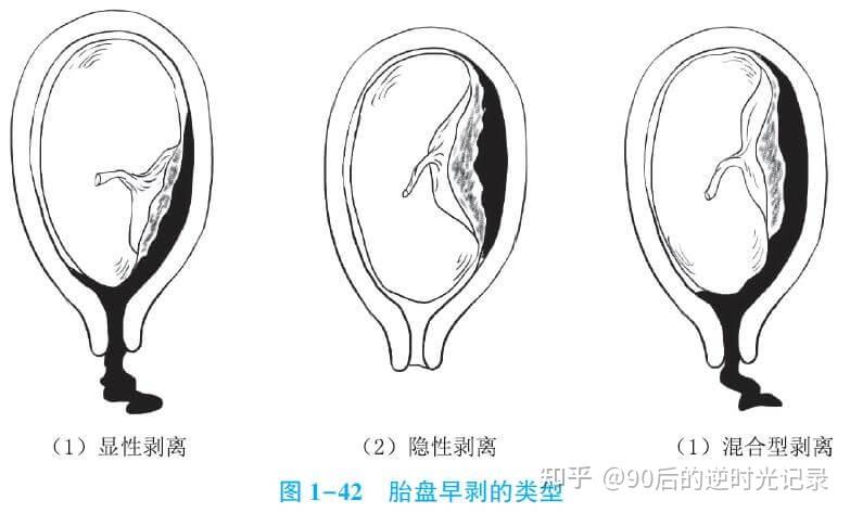 胎盘位于子宫前壁是什么意思?
