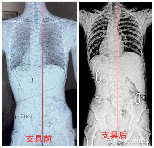 脊柱侧弯参加3天强化班后,剃刀背减少2°,中线基本回直! - 知乎