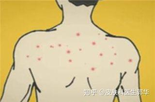 毛囊炎的临床特点及中医疗法 - 知乎