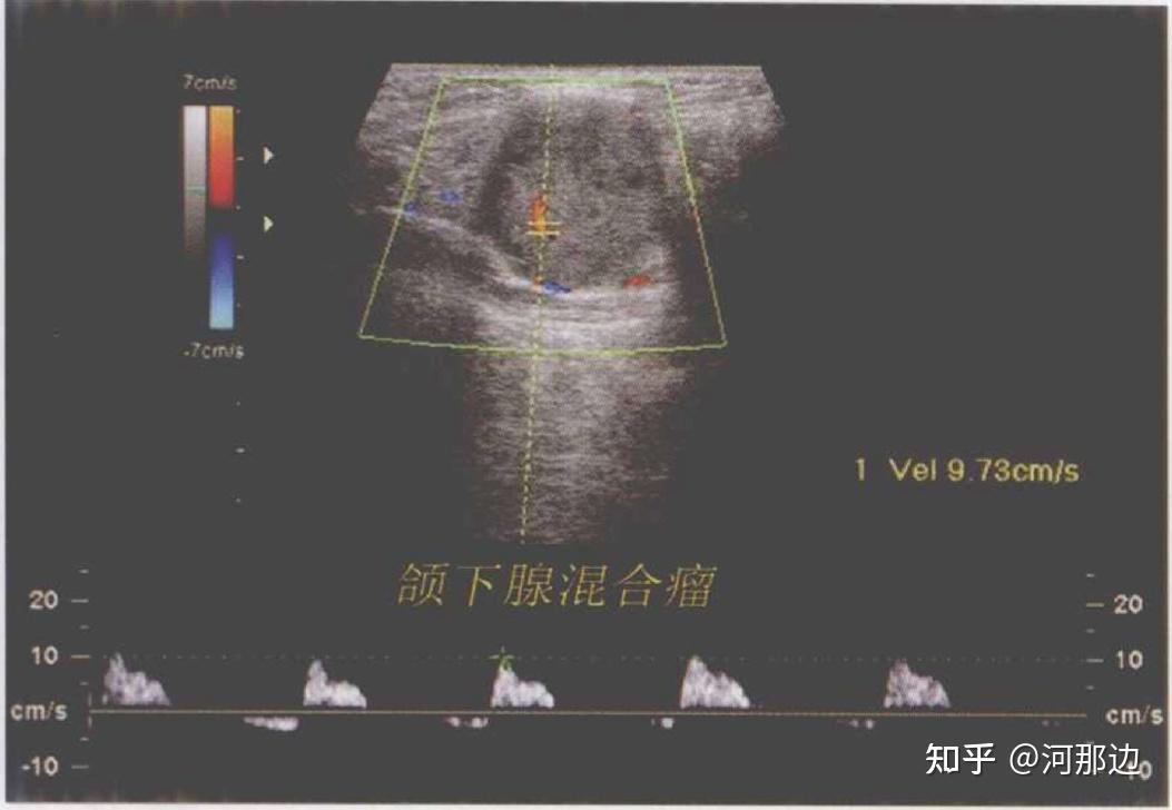 涎腺超声诊断让你不知道的检查技巧与诊断