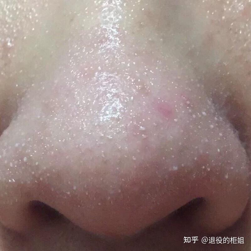 "油脂栓/脂质微丝"到底怎么去除?