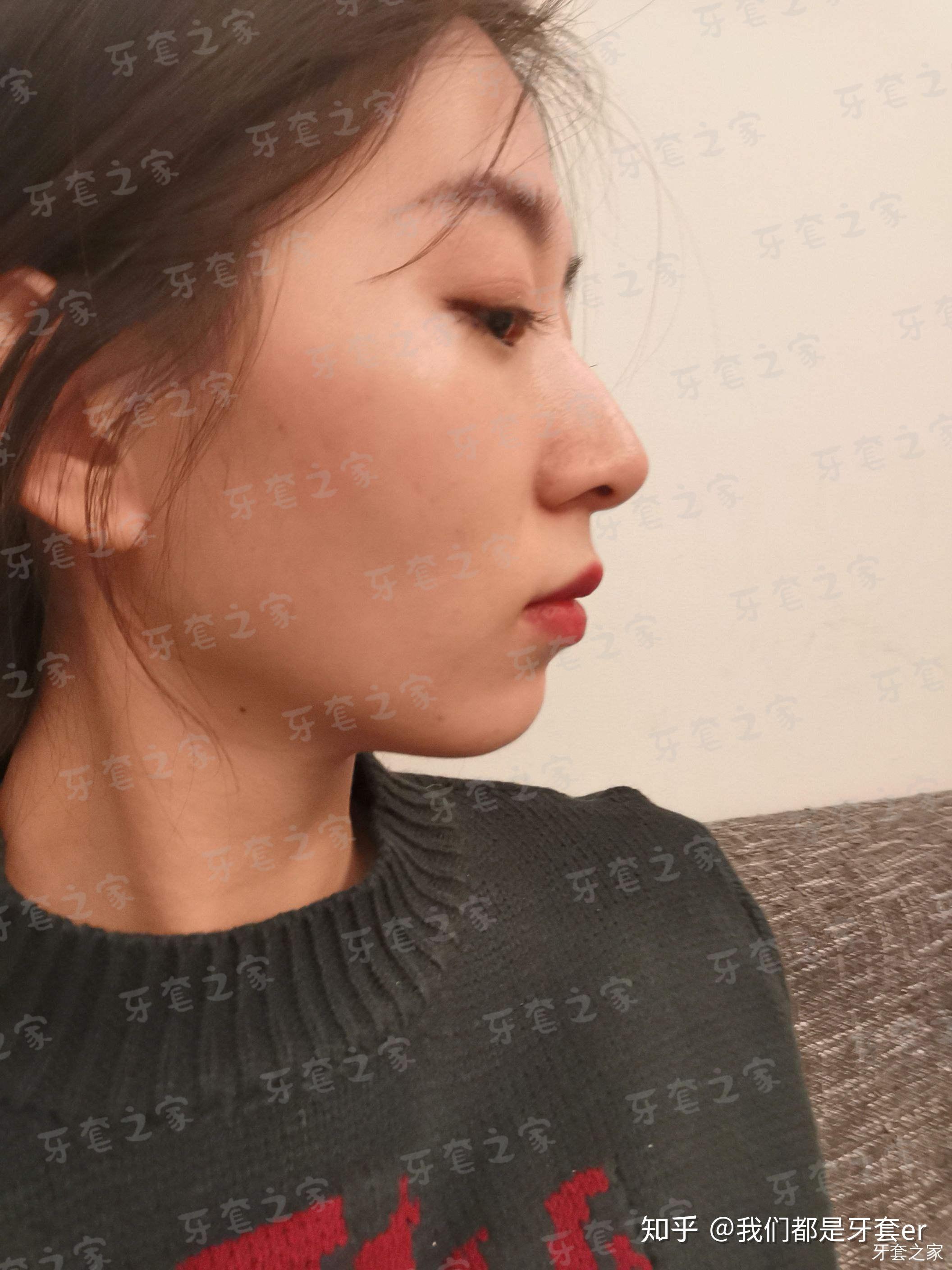 牙齿挺整齐的但是嘴凸特别是上唇正畸有用吗