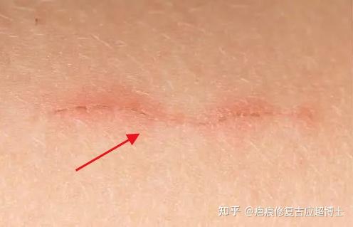 肚子上有明显的手术疤痕影响跳舞吗